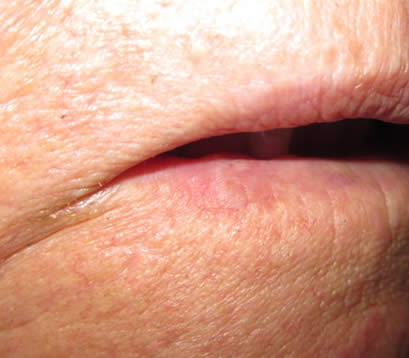 Older patient with skin cancer on lower lip after MOHS surgery 6 months