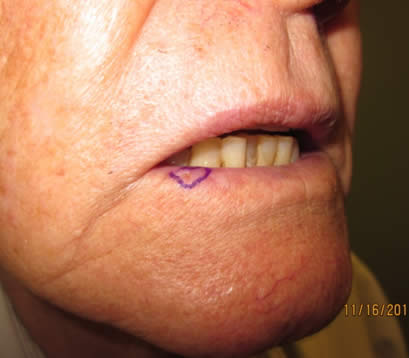 Older patient with skin cancer on lower lip before MOHS surgery