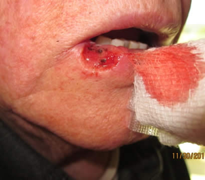 Older patient with skin cancer on lower lip post MOHS open wound