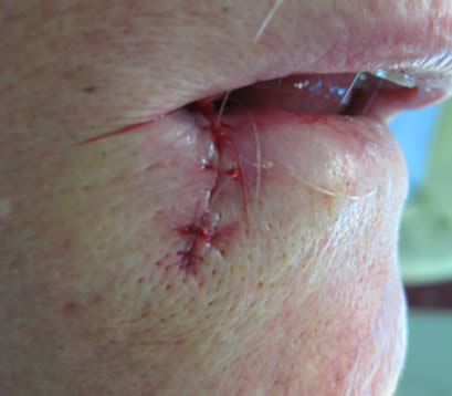 Older patient with skin cancer on lower lip post MOHS surgery closure