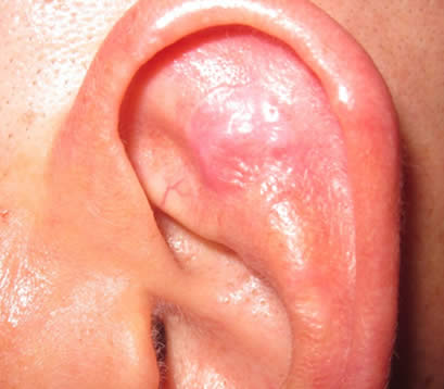 Skin cancer inside left earlobe after MOHS surgery 6 months