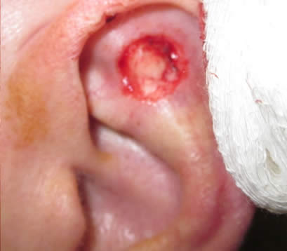 Skin cancer inside left earlobe after MOHS surgery open wound