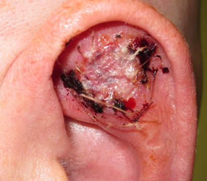 Skin cancer inside left earlobe after MOHS surgery skin graft