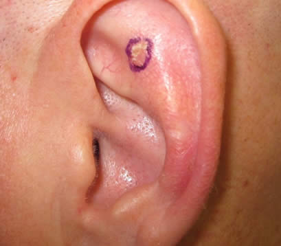 Skin cancer inside left earlobe before MOHS surgery