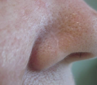 Skin cancer on bottom right of nose after MOHS surgery 6 months