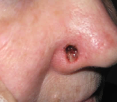 Skin cancer on bottom right of nose after MOHS surgery open wound