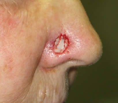 Skin cancer on bottom right of nose after MOHS surgery skin graft