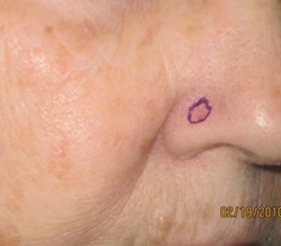 Skin cancer on bottom right of nose before MOHS surgery