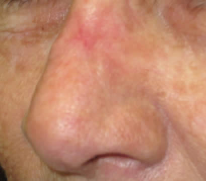Skin cancer on bridge of nose after MOHS surgery 2 months