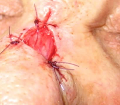 Skin cancer on bridge of nose after MOHS surgery partial closure