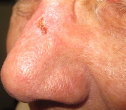 Skin cancer on bridge of nose after MOHS surgery1 month