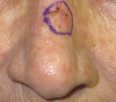 Skin cancer on bridge of nose before MOHS surgery