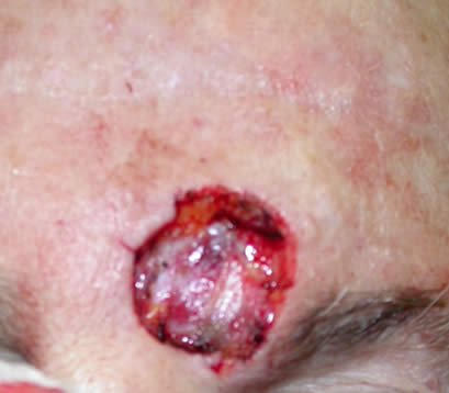 Skin cancer on left eyebrow after MOHS surgery open wound