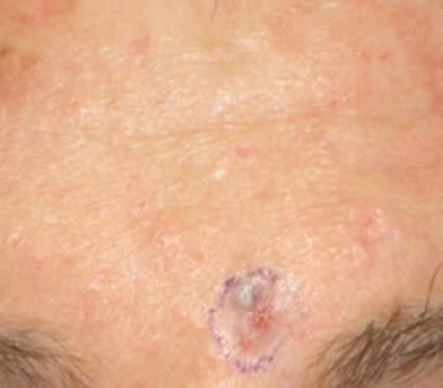 Skin cancer on left eyebrow before MOHS surgery