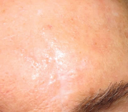 Skin cancer on right temple after MOHS surgery 6 months