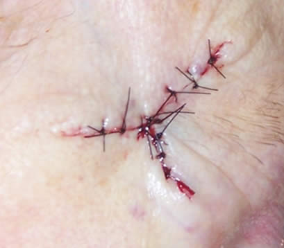 Skin cancer on right temple after MOHS surgery closure