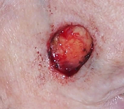 Skin cancer on right temple after MOHS surgery open wound