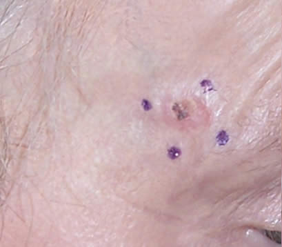 Skin cancer on right temple before MOHS surgery