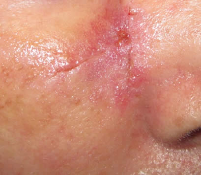 Skin cancer upper right cheek after MOHS surgery 1 week