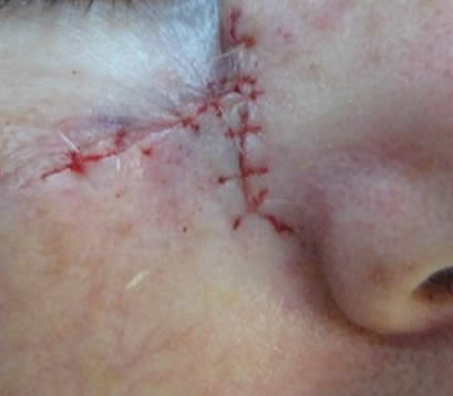 Skin cancer upper right cheek after MOHS surgery closure