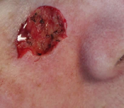 Skin cancer upper right cheek after MOHS surgery open wound