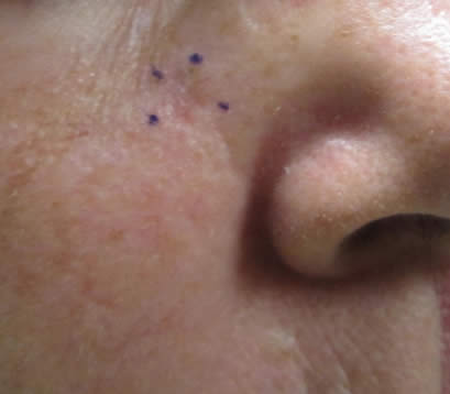 Skin cancer upper right cheek before MOHS surgery