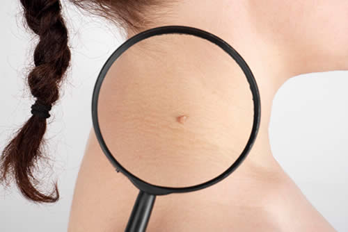 Detecting Melanoma Early